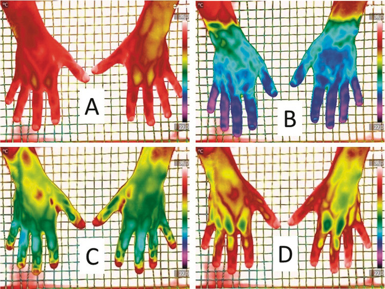 Figur 1  a) Normalt termografi av hendene hos en frisk soldat. Dorsalsiden av h&aring;nd avgir en normal varmestr&aring;ling som ligger&hellip;
