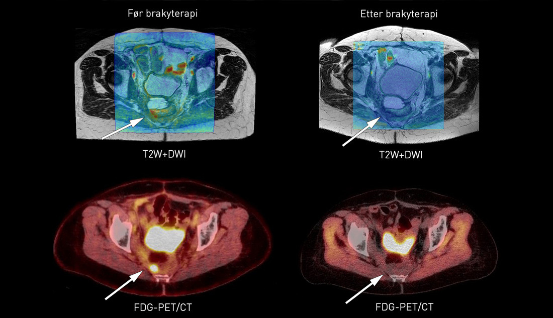 Figur 1  MR- og PET-skann f&oslash;r og ett &aring;r etter behandling med h&oslash;ydose brakyterapi hos pasient med solit&aelig;rt residiv av&hellip;