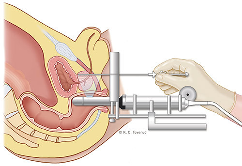 Figur 1  Lavdoserate brakyterapi med transrektal ultralydveiledning. Transperineal implantasjonsteknikk av radioaktive&hellip;