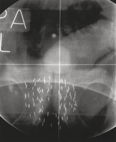 Figur 2  Radiologisk unders&oslash;kelse av bekkenet etter lavdoserate brakyterapi. Multiple radioaktive jodkorn er implantert&hellip;