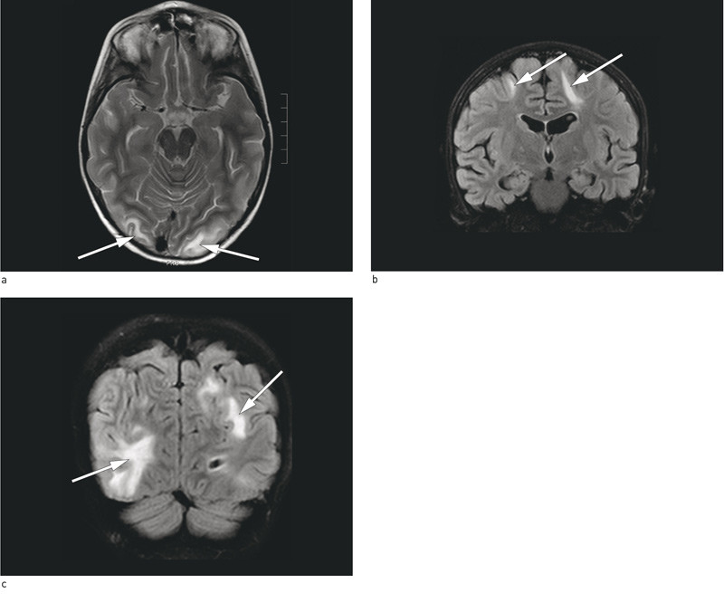 Figur 1  MR-bildene viser h&oslash;ysignalforandringer subkortikalt frontalt og oksipitalt p&aring; begge sider. a) Aksial T2-sekvens. b,&hellip;