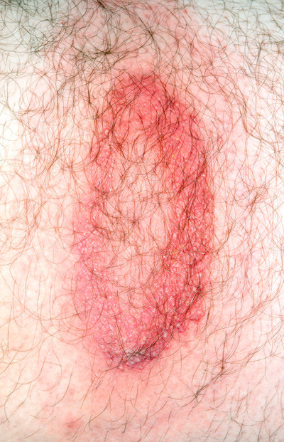 Erythema migrans ved Borrelia burgdorferi-infeksjon etter fl&aring;ttbitt. Foto: Science Photo Library/NTB scanpix