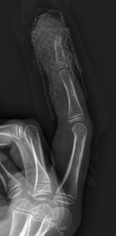 Figur 2  P&aring; r&oslash;ntgen av 3. finger i sideplan ses beindestruksjon i distale falang og bl&oslash;tdelshevelse (OBS bandasje)