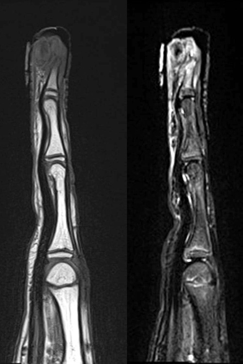 Figur 3  MR av 3. finger, sagittal T1 og STIR. Det ses bl&oslash;tdelsoppfylling, tumorinfiltrasjon ytterst i ytterfalangen og&hellip;