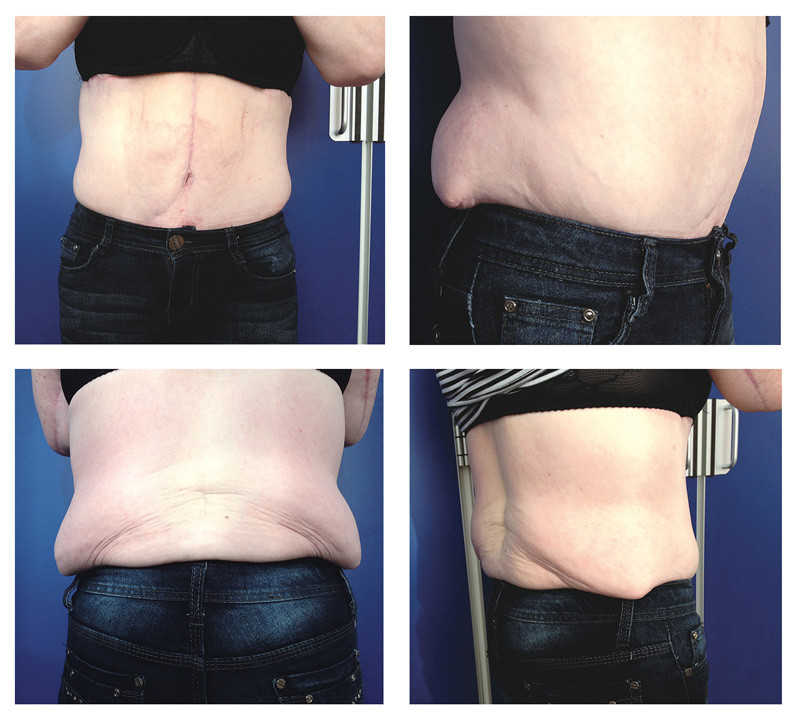 Figur 2  Utilstrekkelig resultat etter utf&oslash;rt bukplastikk hos en pasient som heller skulle hatt nedre kroppsl&oslash;ft. Det&hellip;