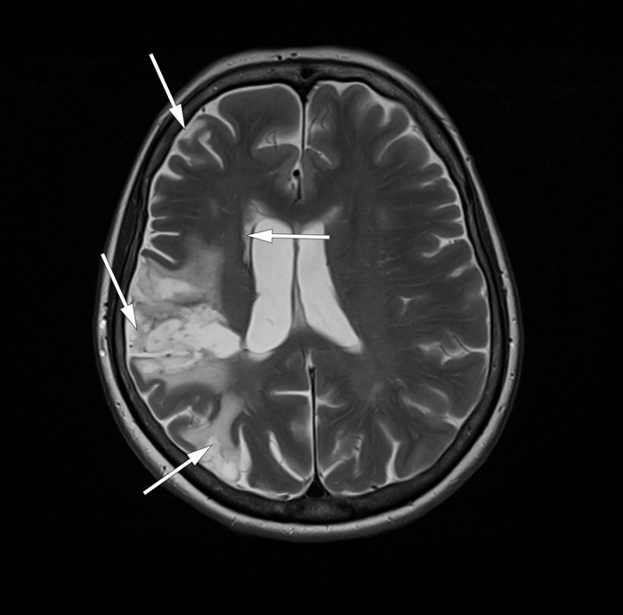 Flere infarkter i h&oslash;yre hemisf&aelig;re. MR caput (T2-vektet)