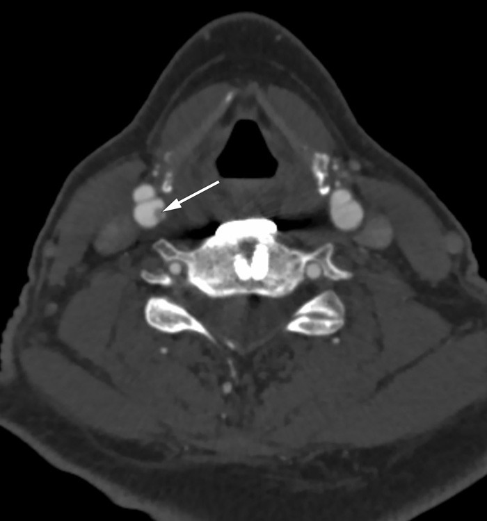 Veggforandringer i h&oslash;yre a. carotis interna. CT-angiografi hals