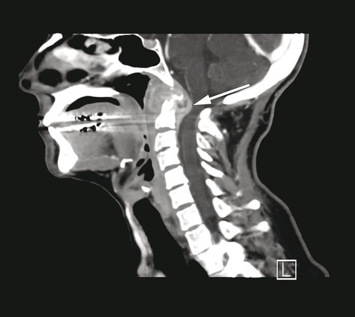 Figur 1  F&oslash;rste CT av cervikalcolumna viser betydelig bl&oslash;tdelshevelse og kontrastoppladning prevertebralt og epiduralt&hellip;