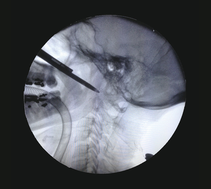 Figur 2  Endoskopisk biopsitaking av prevertebralt omr&aring;de med Weils tang i niv&aring; med fremre atlasbue. Bildet er tatt med&hellip;