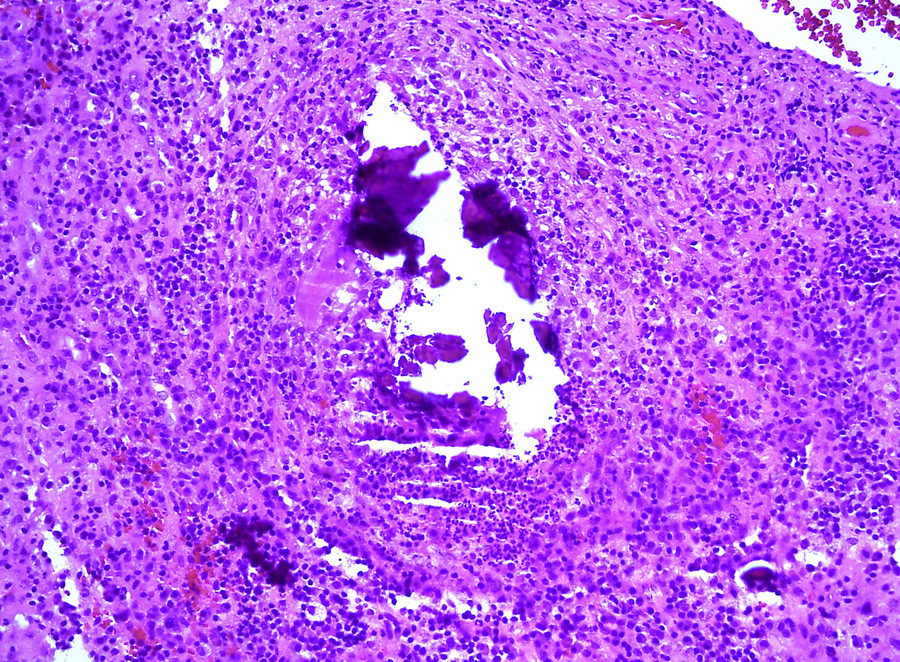 Figur 3  Hematoksylin-eosin-farget histologisk preparat fra prevertebralt omr&aring;de. Snittet viser innslag av kronisk&hellip;