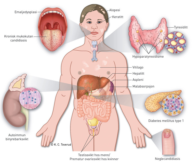 Figur 1  Kliniske manifestasjoner som kan forekomme hos pasienter med autoimmunt polyendokrint syndrom type 1 (APS-1)