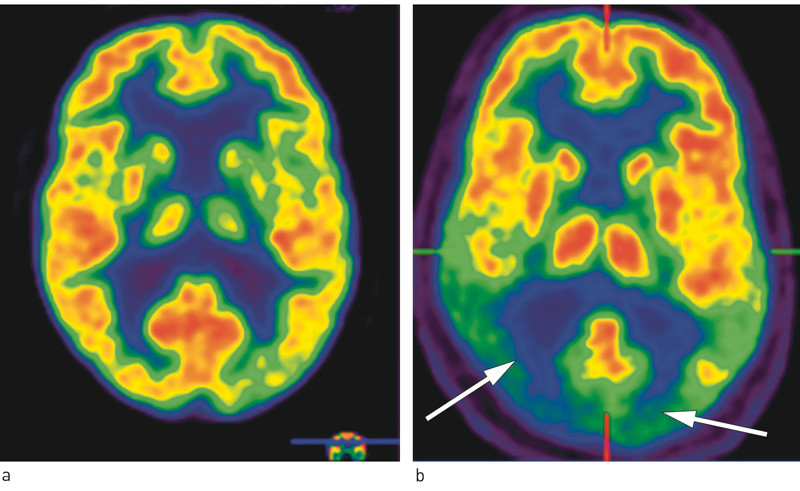 Figur 1  Positronemisjonstomografi (PET) med en radioaktivt merket glukoseanalog (18FDG) er en funksjonell nukle&aelig;rmedisinsk&hellip;