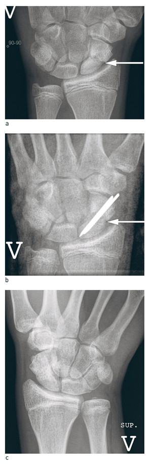 Figur 5  Behandling av skafoidpseudartrose. a) 18 m&aring;neder gammel skafoid pseudartrose (hvit pil) hos ung mann, b) Operert&hellip;