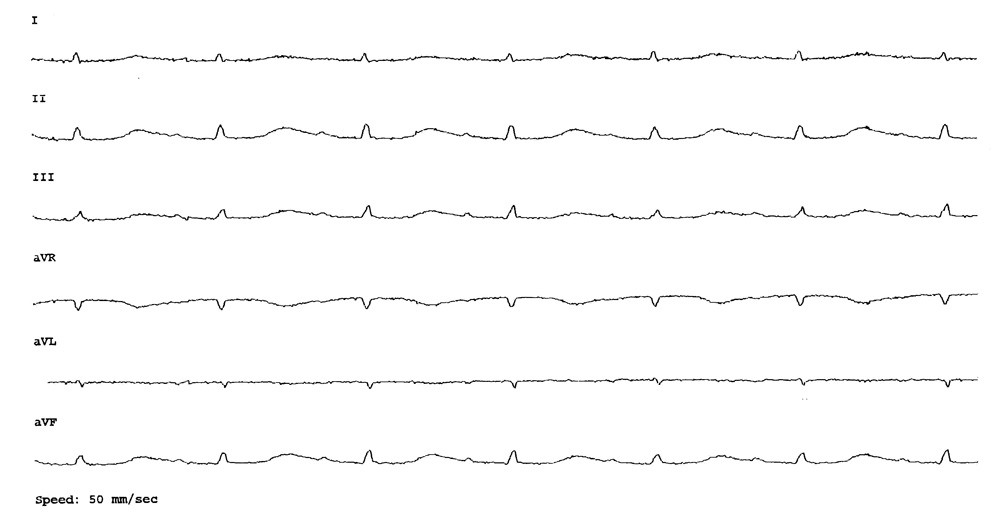 Figur 1  EKG viser sinusrytme med frekvens 79 per minutt, forlenget PQ-tid (0,23 s, referanse 0,12&thinsp;&ndash;&thinsp;0,20) og uspesifikke T&hellip;