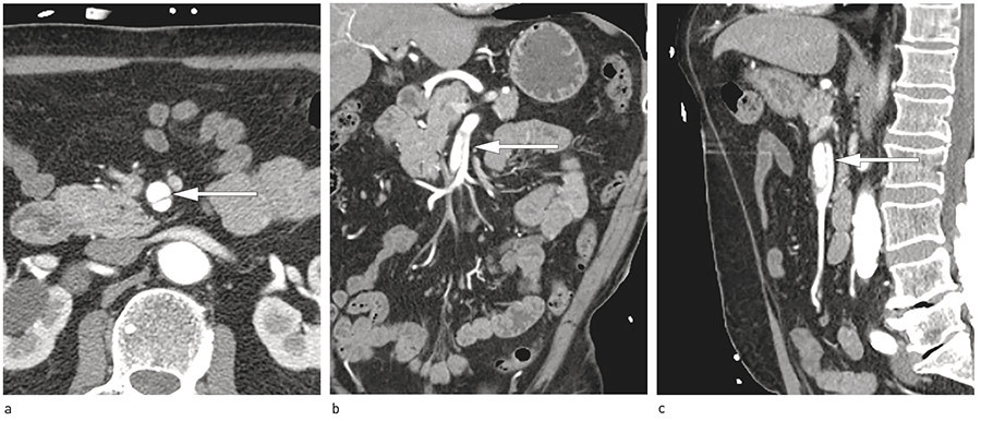 Figur 1 CT-angiografi totalaorta. a) Aksialt, b) koronalt og c) sagittalt snitt av arteria mesenterica superior-disseksjon &hellip;