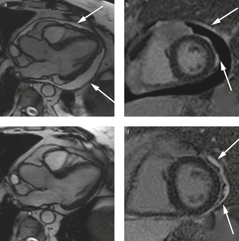 Figur 2  a) Hjerte-MR (trekammer endediastole) tatt ved innleggelsen viste god venstre ventrikkel-funksjon og rikelig med&hellip;