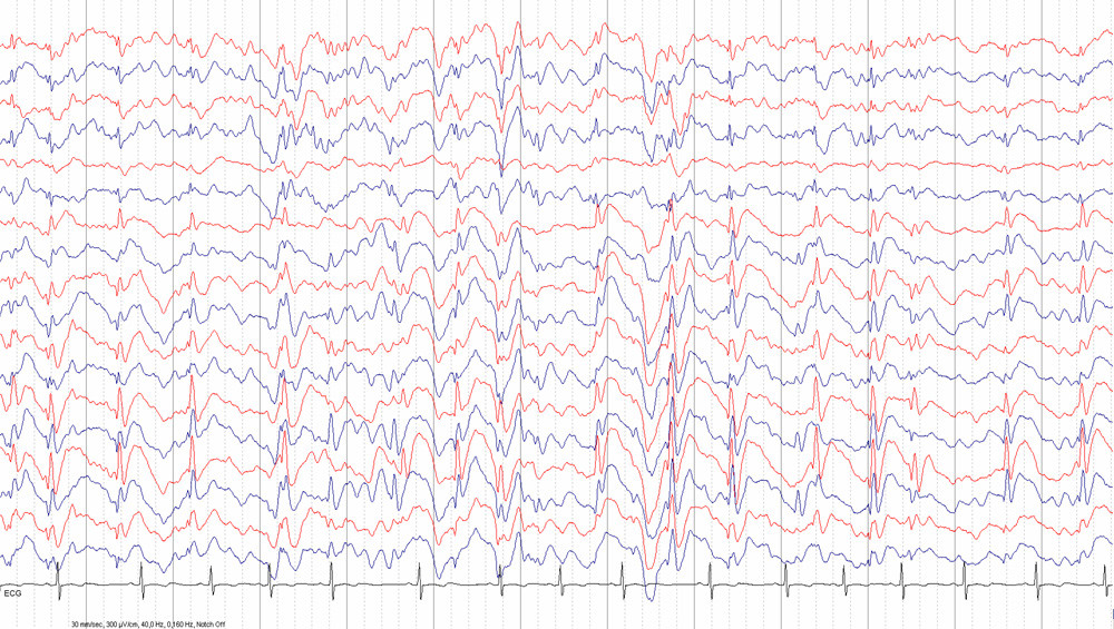 Figur 1  EEG tatt under ikke-REM-s&oslash;vn. Det er intens &oslash;kning av den epileptiske aktiviteten, med venstresidig dominans (r&oslash;dt)