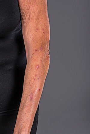 Figur 1  V&aring;r pasient med eksoriasjoner og arrforandringer dorsolateralt p&aring; venstre arm. Foto: Kristin Ellefsen, Foto- og&hellip;