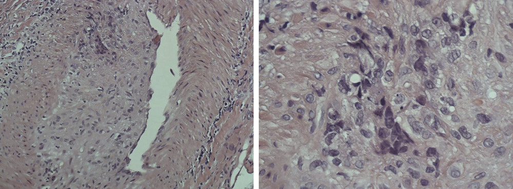 E-figur Figuren viser to hematoksylin-eosin-snitt. Bildet til venstre er tatt gjennom mikroskop innstilt p&aring; 100 x&hellip;