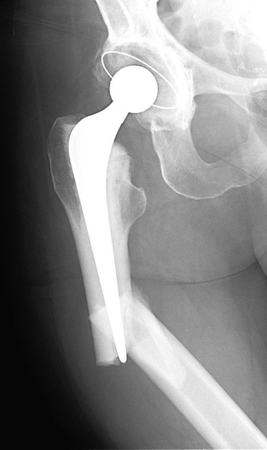 Figur 1  Periprostetisk fraktur, h&oslash;yre femur. Frakturlinje 90 grader p&aring; en fortykket lateral cortex (kriterium p&aring; atypisk&hellip;