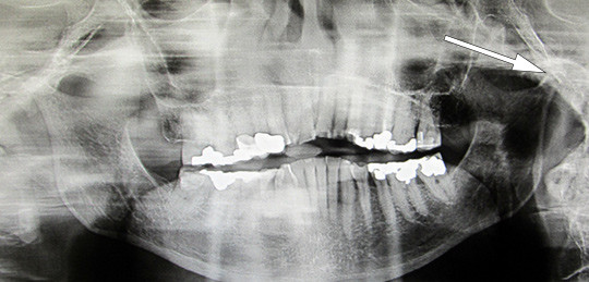 Figur 4  Ortopantomogram (OPG) av mandibula viser destruksjon av begge kondyler, mest uttalt p&aring; venstre side. Se pil