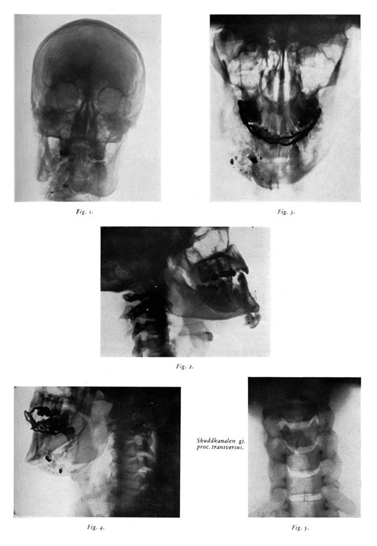 Figur 2  Faksimile fra kasuistikken i Tidsskriftet, her r&oslash;ntgenbilder tatt av pasienten i 1945, fem &aring;r etter at han ble&hellip;