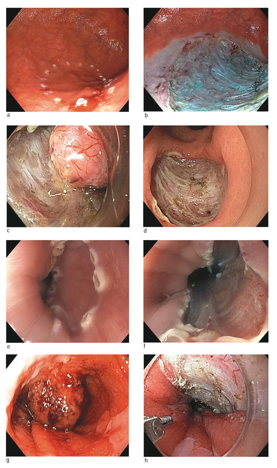 Figur 2  a) I magesekken ses ofte dysplasi i helt flat mucosa, her avgrenset med hvite diatermimarkeringer. b) En homogen&hellip;
