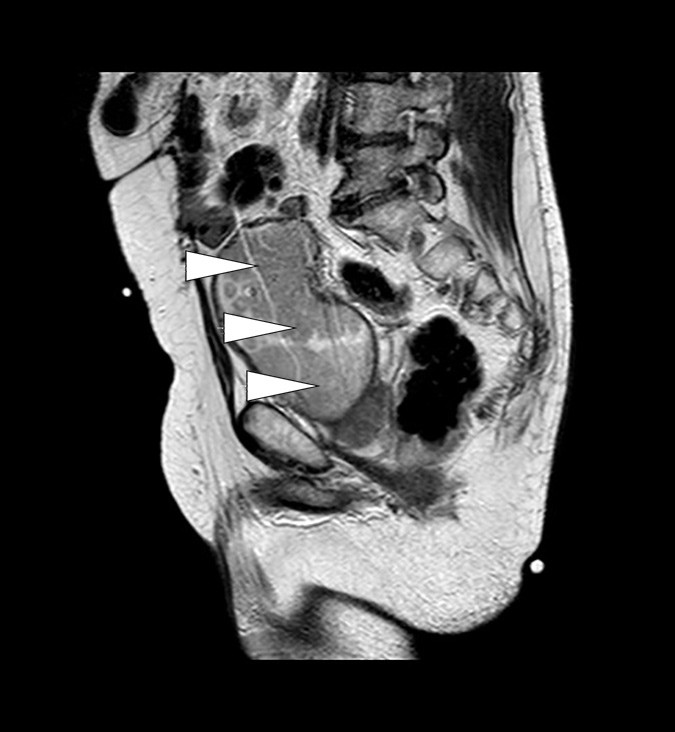 Figur 2  MR bekken (T2-vektet) i sagittal projeksjon med bl&aelig;retumor (piler)