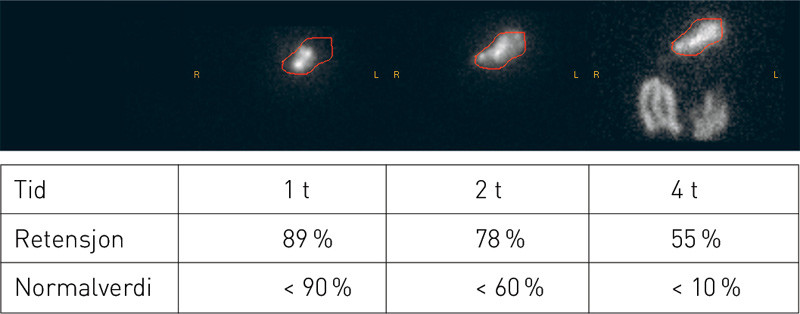 Figur 3  Illustrasjonen viser ventrikkelscintigrafi hos en pasient med alvorlig diabetisk gastroparese. Vi ser stor&hellip;