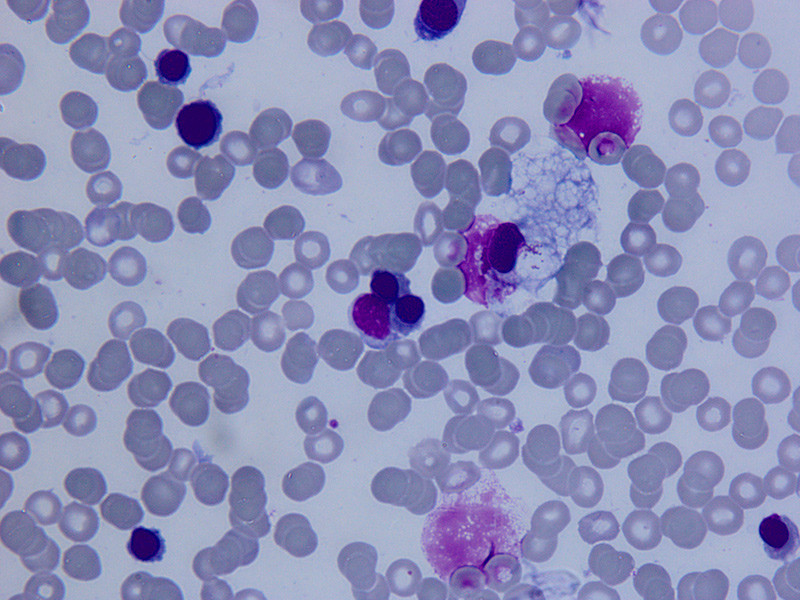 Figur 1  Lysmikroskopisk bilde av benmargsutstryk farget med May-Gr&uuml;nwald-Giemsa. Det ses anisopoikilocytose og patologiske&hellip;