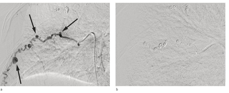 Figur 2  Endovaskul&aelig;r intervensjon med coiling. 8. interkostalarterie er alt behandlet. De st&oslash;rste aneurismene er markert&hellip;