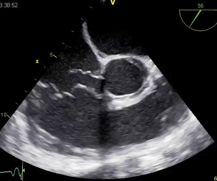 Figur 1  Trans&oslash;sofageal ekkokardiografi som viser sinus valsalvae-aneurisme med ruptur fra aortaroten til h&oslash;yre atrium