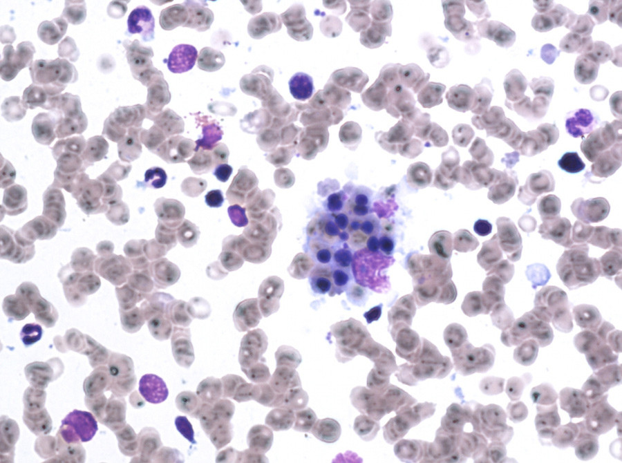 Figur 1  Bilde av pasientens beinmargsaspirat med enkelte stromale makrofager med fagocytterte erytrocytter. I cytoplasma&hellip;