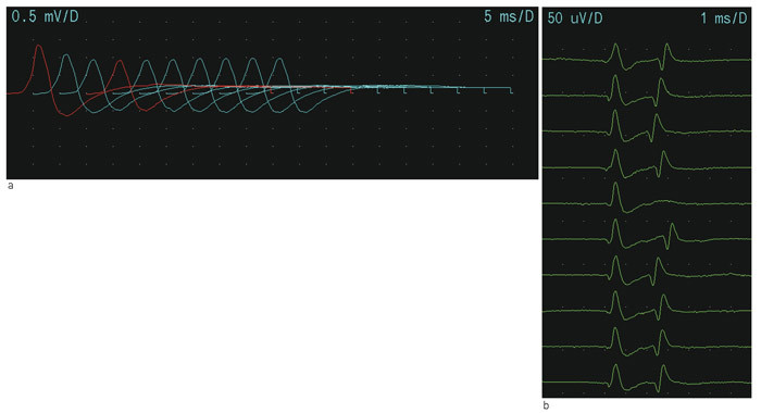 Figur 2  a) Repetitiv nervestimulering. Registrerende elektrode plasseres over muskelen (ved myasteni er proksimal muskel&hellip;