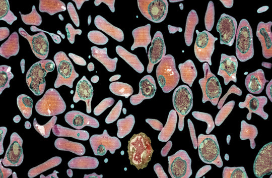 Transmisjonselektronmikrografi av r&oslash;de blodceller infisert av malaria. Foto: Science Photo Library