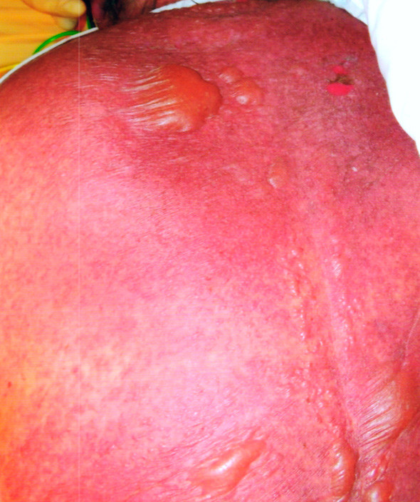 Figur 2  I l&oslash;pet av de f&oslash;rste dagene etter innleggelsen ble det hissigere og mer sammenflytende erytemer samt &oslash;kende&hellip;