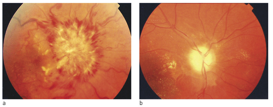 Figur 1  a) Fulminant papill&oslash;dem. b) Sluttresultat: optikusatrofi