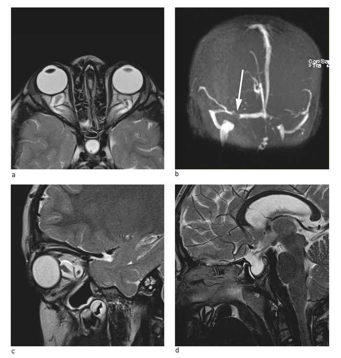 Figur 2  a) Utvidet subaraknoidalrom rundt n. opticus. b) Sinusvenestenose. c) Slynget n. opticus med v&aelig;ske rundt. d) Tom&hellip;