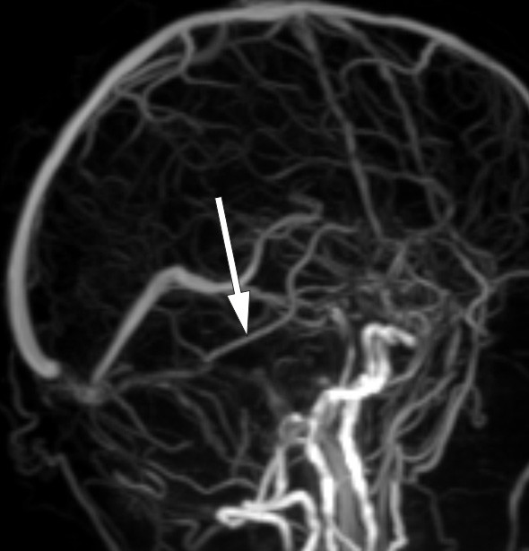 Figur 3  Ven&oslash;s MR-angiografi (TOF-sekvens) viser god fylling av kontralaterale vena Labb&eacute; (pil), mens ipsilaterale vene ikke&hellip;