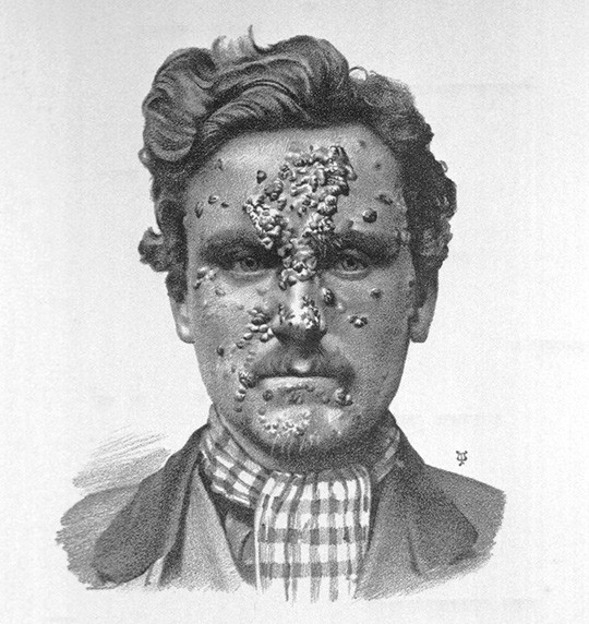 Sekund&aelig;r syfilis med hudforandringer i ansiktet. Illustrasjon fra 1800-tallet. Science Photo Library