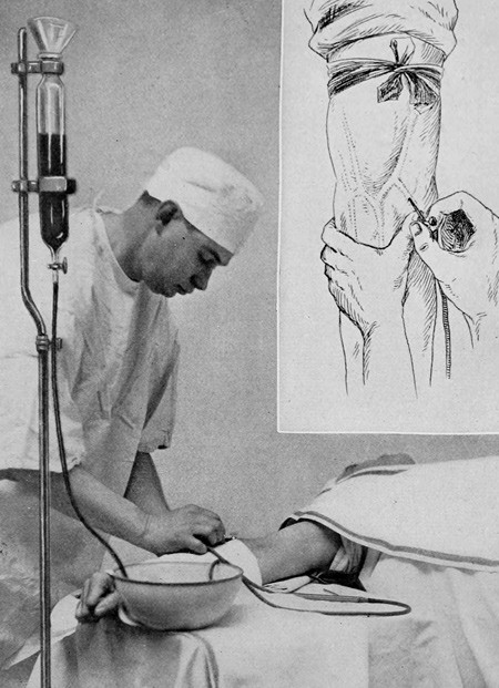 Slik skulle Salvarsan injiseres, if&oslash;lge en illustrasjon fra 1915. Fra boken Applied Immunology. The Practical Application of&hellip;