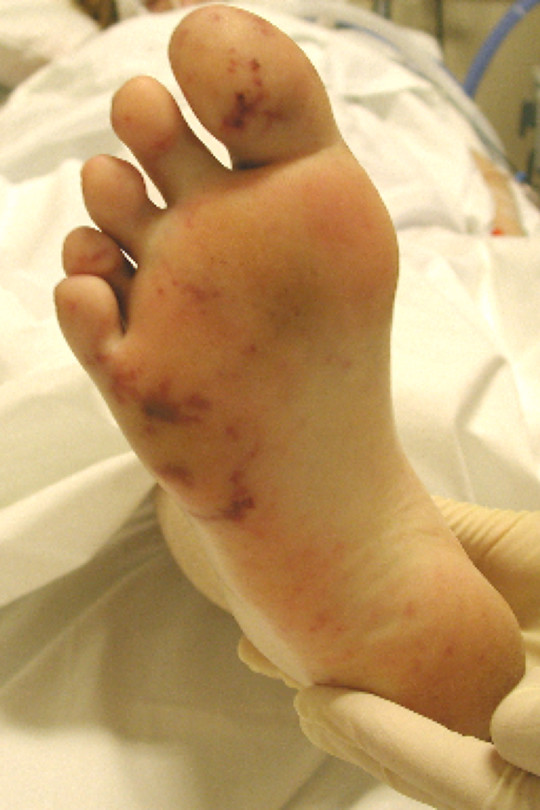 Figur 1  Janeways lesjon