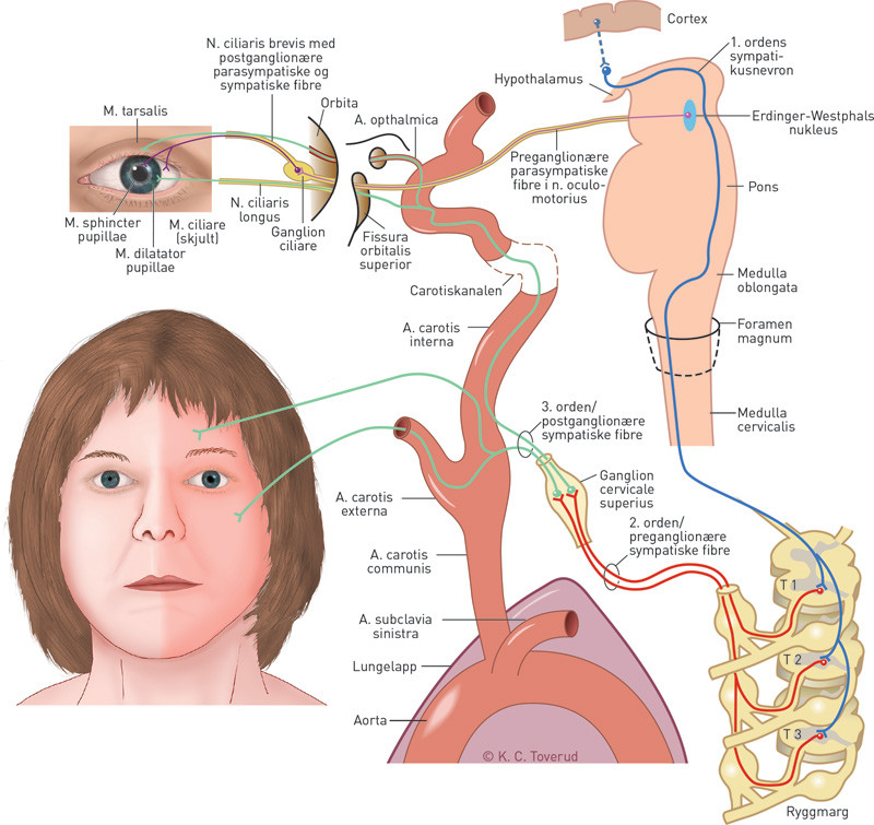 Figur 1  Ved fysisk stress ble pasienten r&oslash;d kun p&aring; den ene siden av ansiktet. Her er en skjematisk fremstilling av&hellip;
