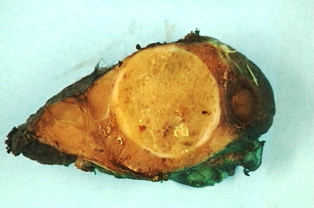 Figur 1  Bilde (makroskopisk) fra venstre thyreoidealapp med en stor og flere mindre knuter. Begge foto: Krystyna Kotanska&hellip;