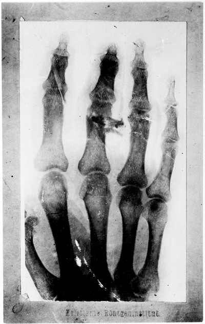 Figur 3  R&oslash;ntgenogram av Edvard Munchs venstre h&aring;nd viser skade p&aring; 3. og 4. finger. Foto: Kristiania R&oslash;ntgeninstitutt. Kopi&hellip;