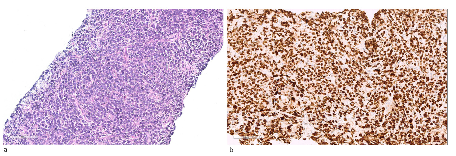Figur 4 Histopatologisk diagnostikk. a) Viser hematoksylin-eosin-farga snitt med diffust infiltrat av noks&aring; store lymfoide&hellip;