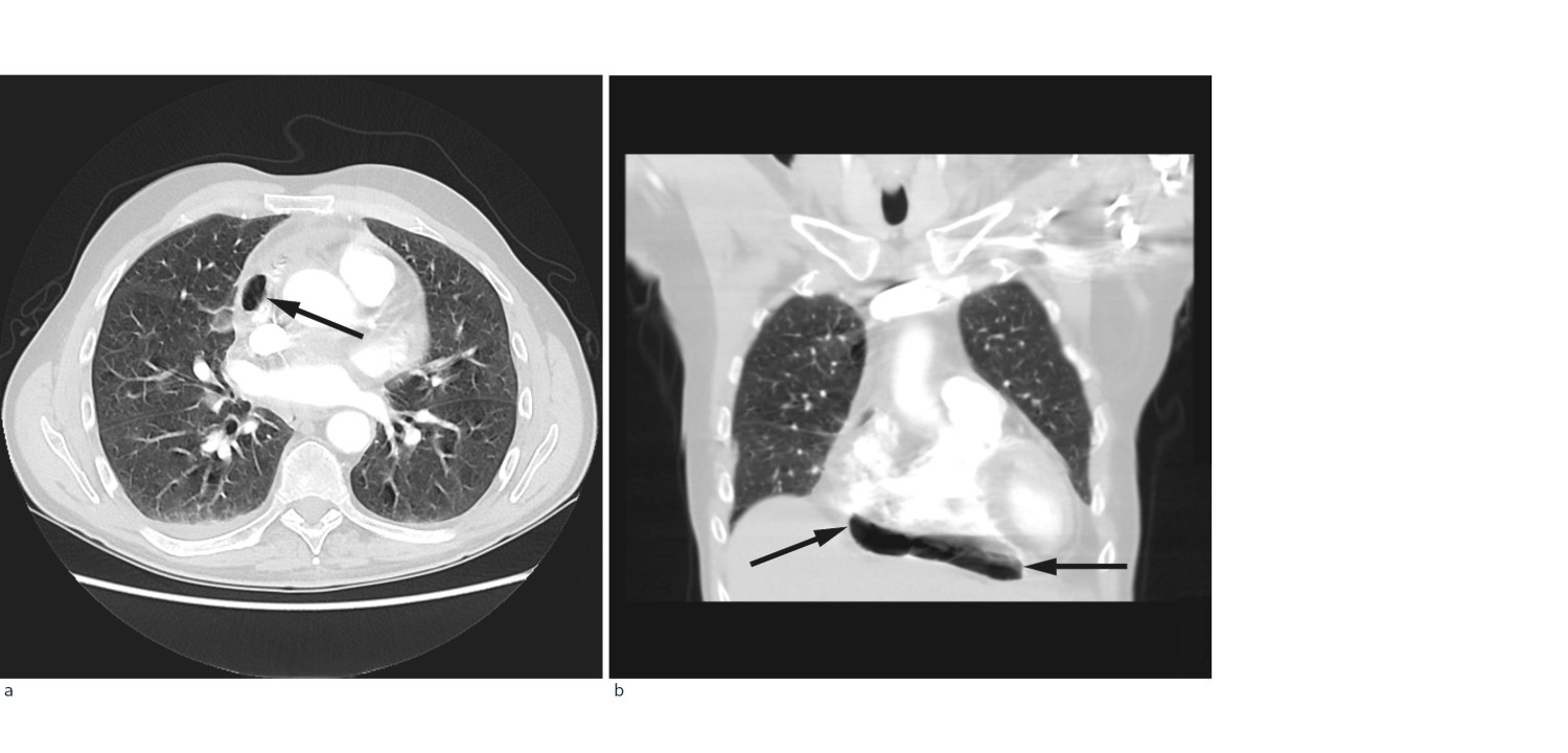 Figur 1 CT etter lungeemboliprotokoll i tidlig kontrastfase i transversal- (a) og koronalplan (b) viser pneumoperikard &hellip;