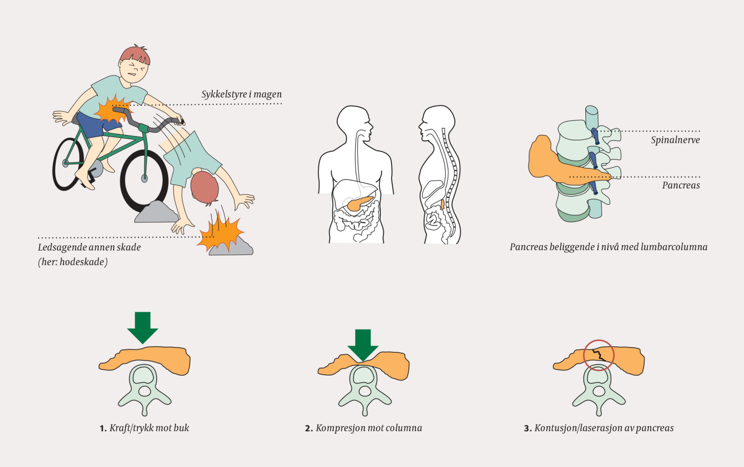 Figur 1 Pancreasskade hos barn ved sykkelstyreulykke. Pancreas presses mot columna, som f&oslash;rer til kompresjon og kontusjon av&hellip;