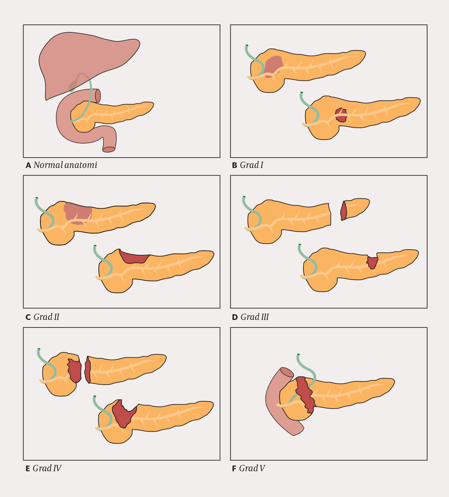 Figur 3 Illustrasjon p&aring; skadegrad, etter The American Association for the Surgery of Trauma (30)