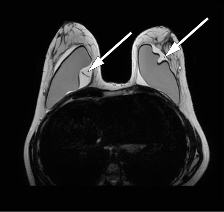 Figur 2 MR mammae, T2-vektet serie. Mistanke om proteseruptur bilateralt. En god del v&aelig;ske omkring implantatene bilateralt